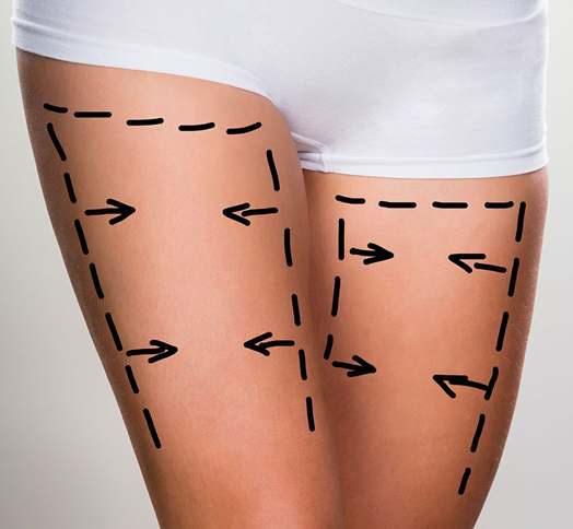 Image de liposuccion des cuisses en Tunisie
